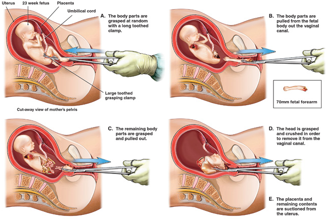 dilationevacuation