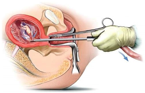 Passing clots/tissue after D&C (pic) - Miscarriage Support, Forums