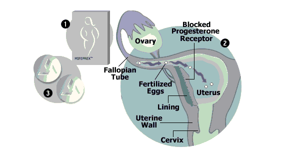 The Medical Abortion Safeparenthood Malaysia